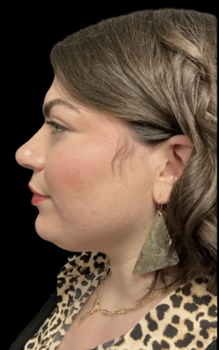 Kybella before treatment at Juvly Aesthetics