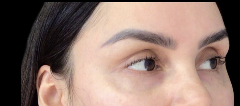 Under-Eye Treatments before treatment at Juvly Aesthetics