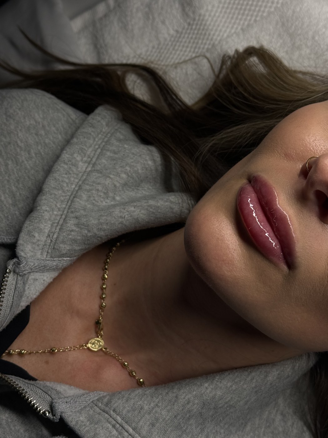 Close-up of smooth, softly defined lips after hyaluronic acid lip filler