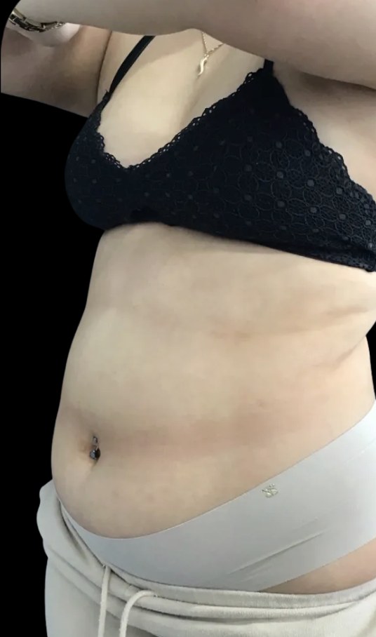 Wellness Rx Membership before treatment at Juvly Aesthetics