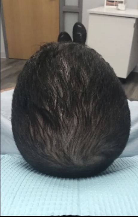 Hair Loss Treatments after treatment at Juvly Aesthetics