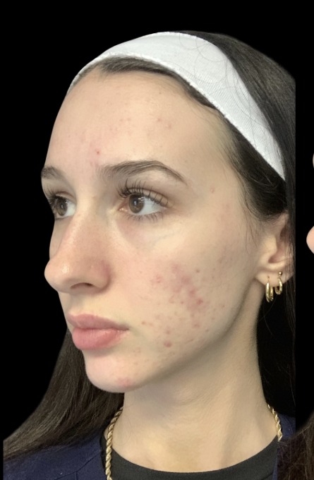 Standard Microneedling before treatment at Juvly Aesthetics