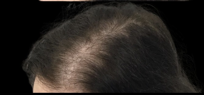 Hair Loss Treatments after treatment at Juvly Aesthetics