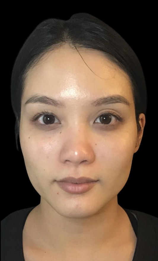 JLyft Non-Surgical Facelift before treatment at Juvly Aesthetics