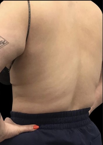 CoolSculpting after treatment at Juvly Aesthetics