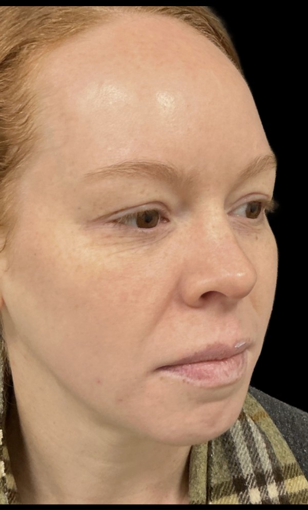 Laser after treatment at Juvly Aesthetics