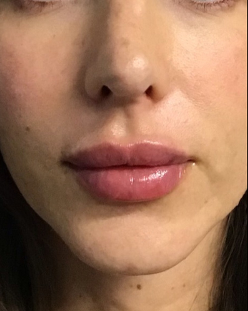 Lip filler after treatment at Juvly Aesthetics