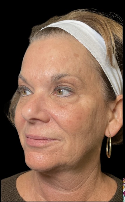 XTherma before treatment at Juvly Aesthetics