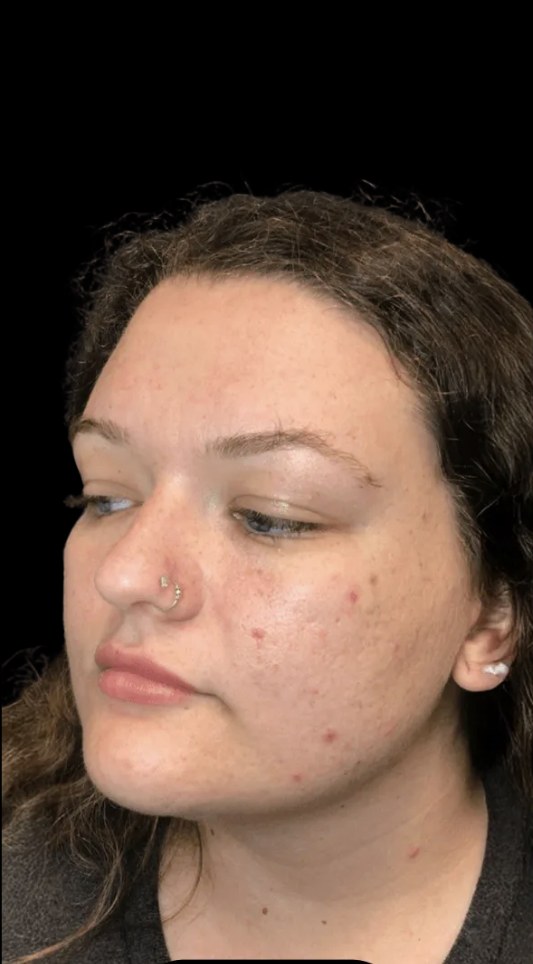 Standard Microneedling before treatment at Juvly Aesthetics