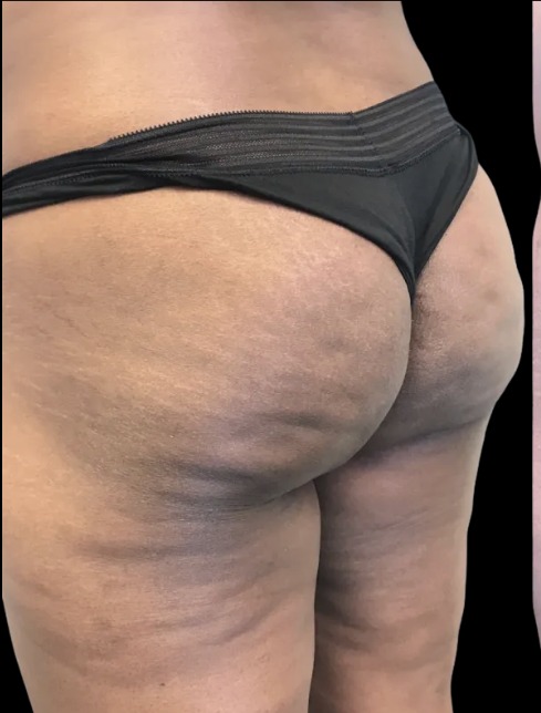 Non-Surgical BBL before treatment at Juvly Aesthetics