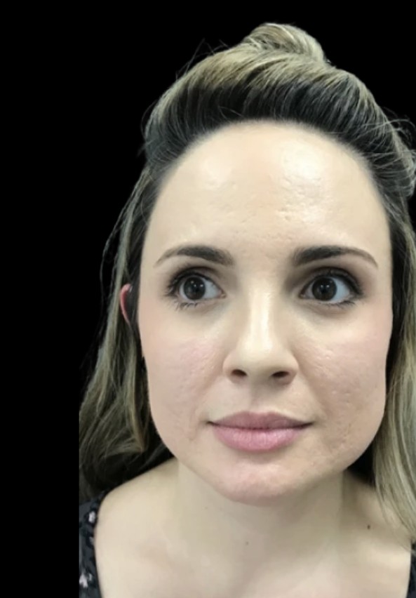 Masseter Slimming before treatment at Juvly Aesthetics