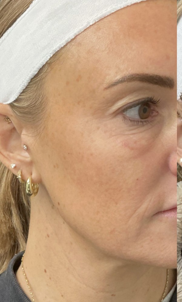 Laser before treatment at Juvly Aesthetics