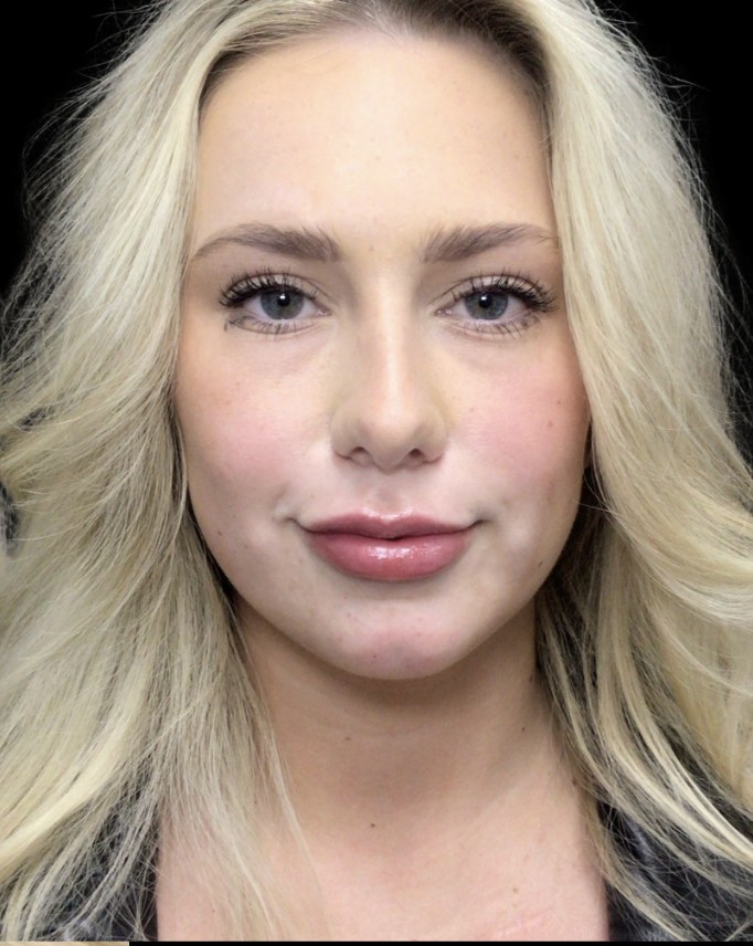 Lip filler after treatment at Juvly Aesthetics