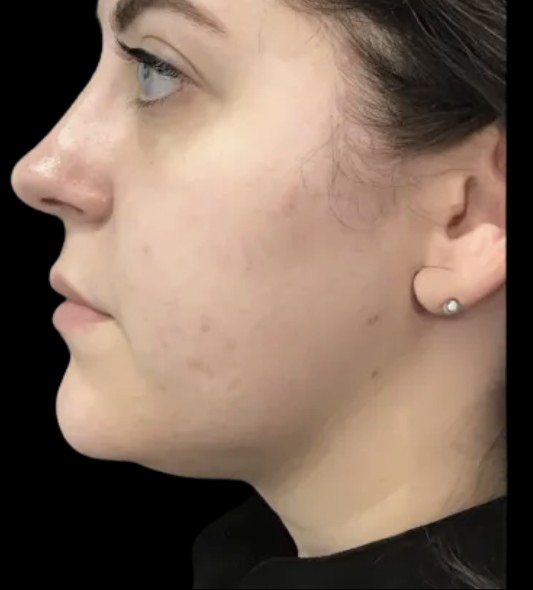 CoolSculpting Submental before treatment at Juvly Aesthetics
