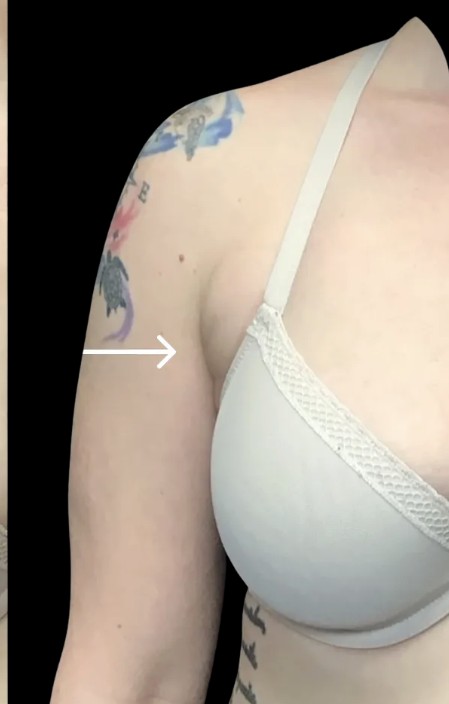 Kybella after treatment at Juvly Aesthetics