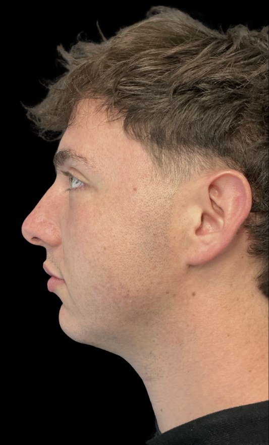 JLyft Non-Surgical Facelift before treatment at Juvly Aesthetics