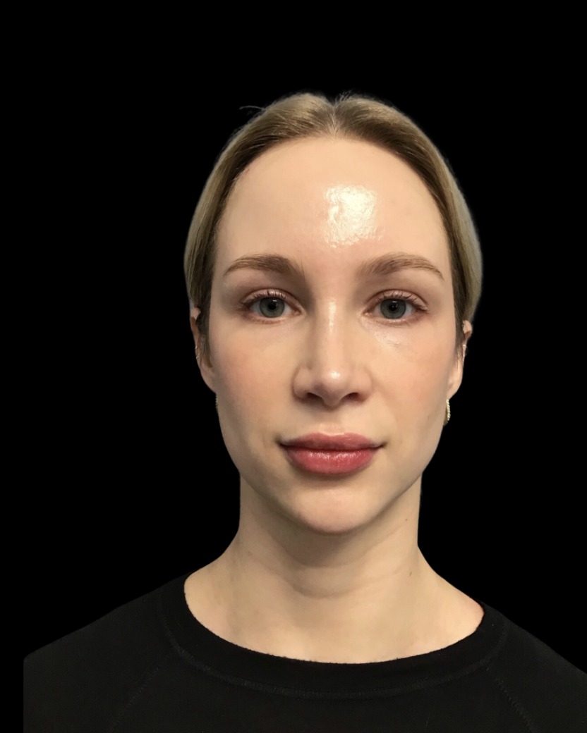 Chin Filler after treatment at Juvly Aesthetics