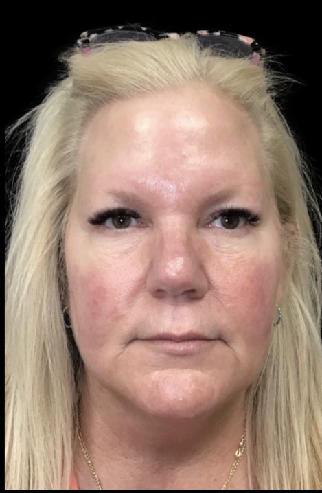 Laser before treatment at Juvly Aesthetics