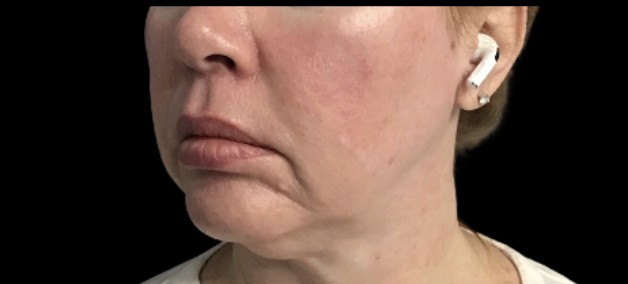 Sylfirm X before treatment at Juvly Aesthetics