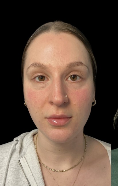 Under-Eye Treatments before treatment at Juvly Aesthetics