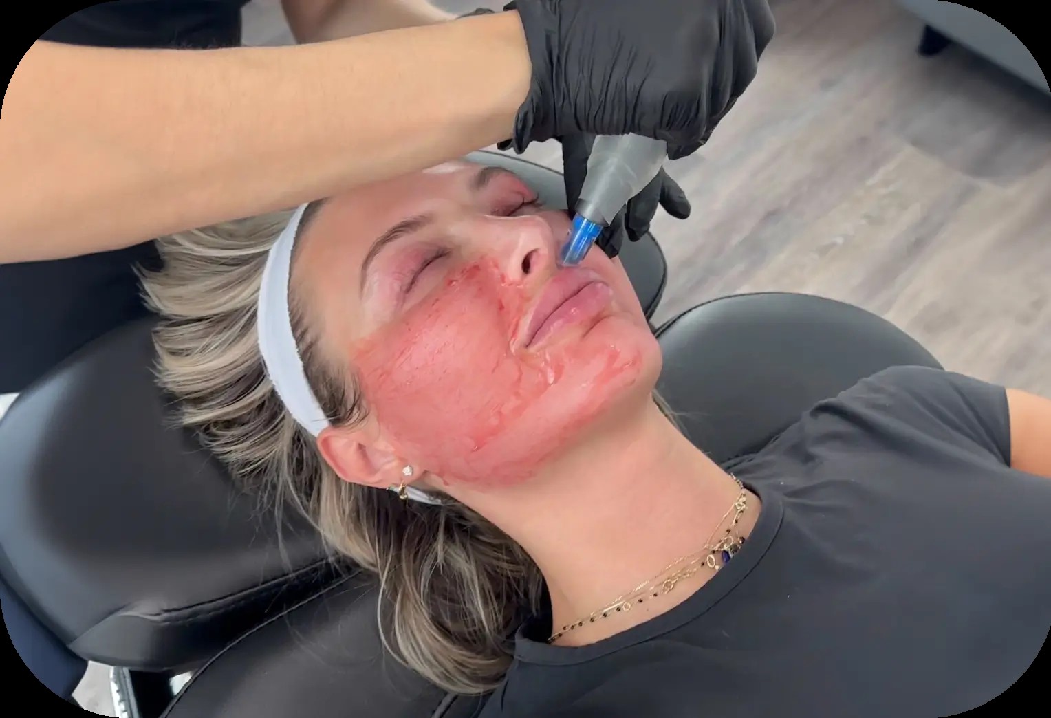 Microneedling treatment at Juvly Aesthetics