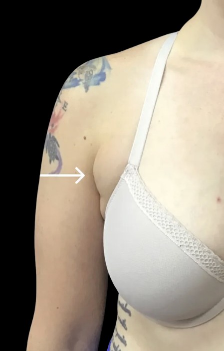Kybella before treatment at Juvly Aesthetics