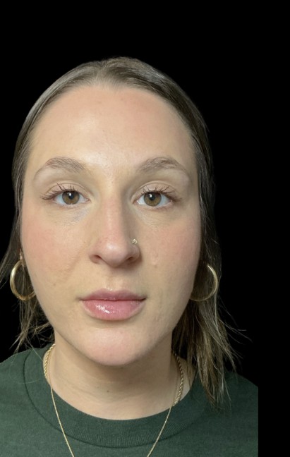 Under-Eye Treatments after treatment at Juvly Aesthetics