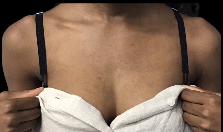 Chemical Peel before treatment at Juvly Aesthetics