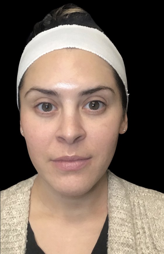 Wrinkle Relaxers after treatment at Juvly Aesthetics