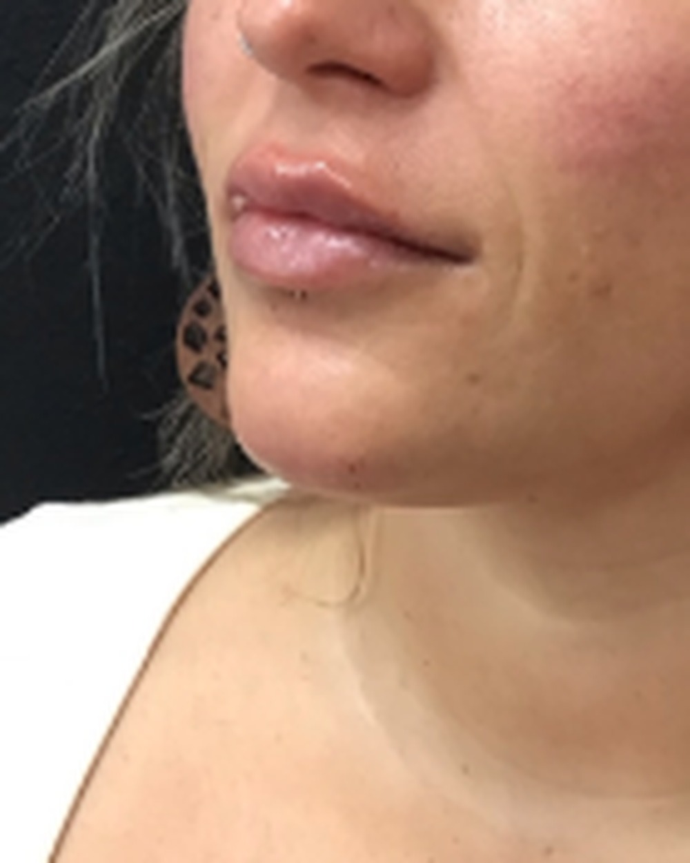 Lip filler after treatment at Juvly Aesthetics