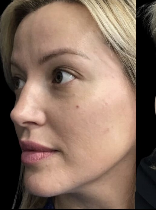 Chemical Peel before treatment at Juvly Aesthetics