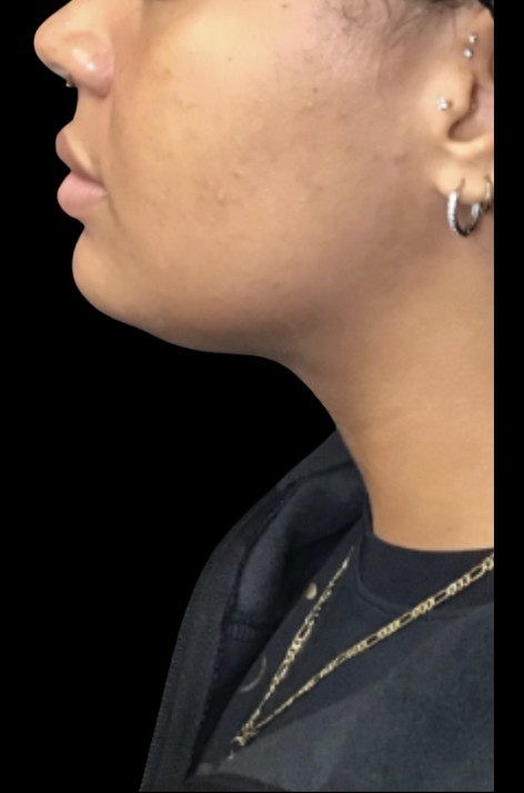CoolSculpting Submental after treatment at Juvly Aesthetics