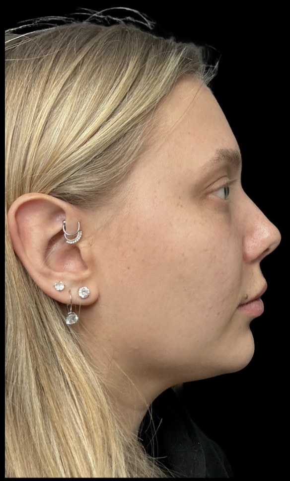 Standard Microneedling after treatment at Juvly Aesthetics