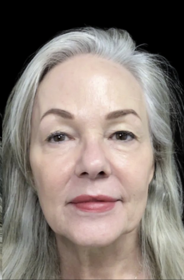 Standard Microneedling after treatment at Juvly Aesthetics