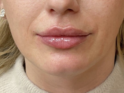 Lip filler after treatment at Juvly Aesthetics