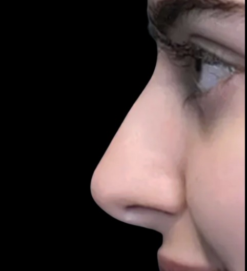 Liquid Nose Job after treatment at Juvly Aesthetics