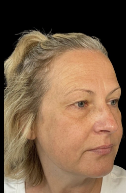 JLyft Non-Surgical Facelift before treatment at Juvly Aesthetics