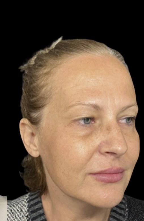 JLyft Non-Surgical Facelift after treatment at Juvly Aesthetics