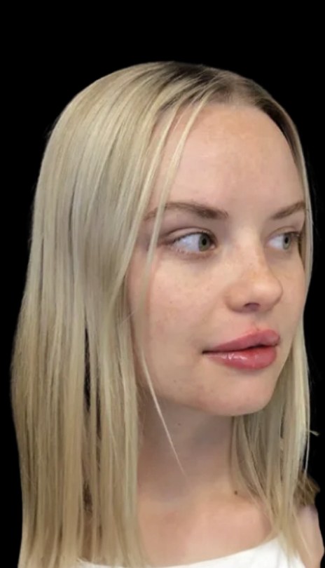 Lip filler after treatment at Juvly Aesthetics