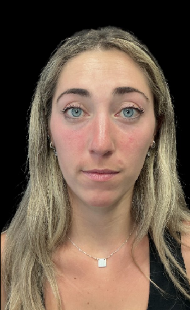 Wrinkle Relaxers before treatment at Juvly Aesthetics