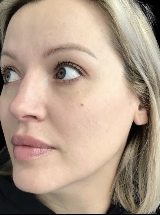 Chemical Peel after treatment at Juvly Aesthetics