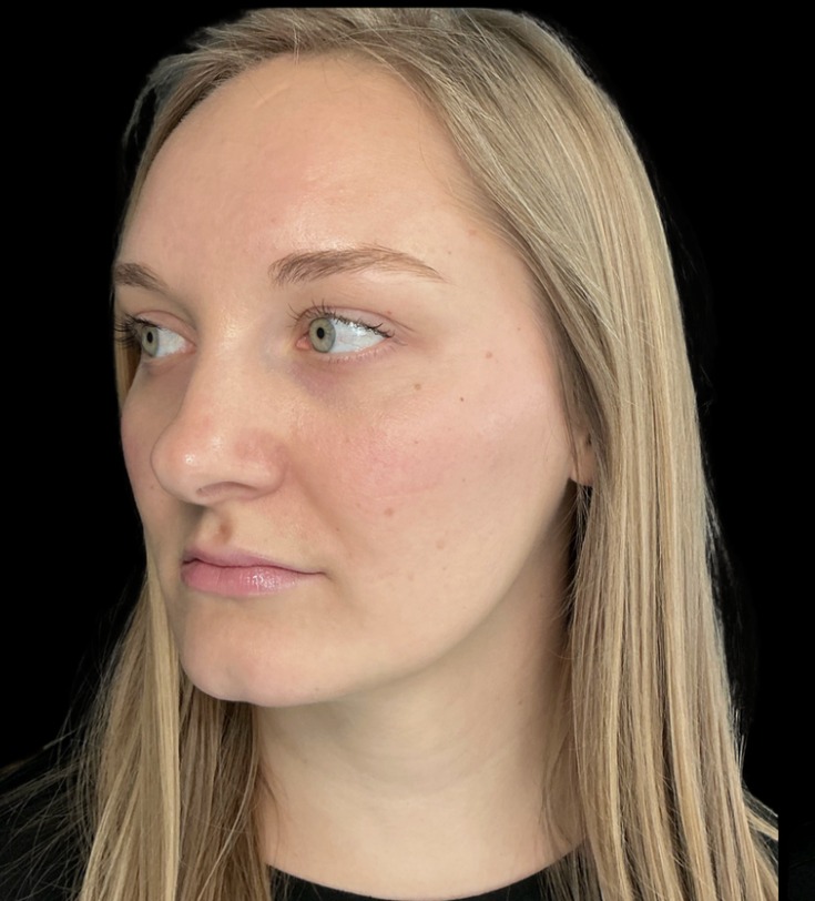 Chin Filler before treatment at Juvly Aesthetics