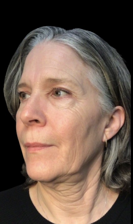 Under-Eye Treatments after treatment at Juvly Aesthetics