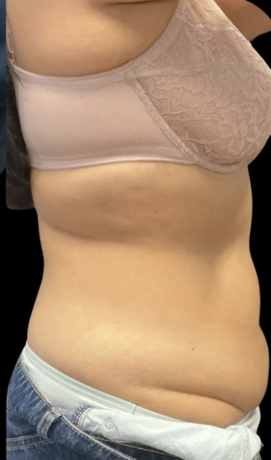 Wellness Rx Membership after treatment at Juvly Aesthetics
