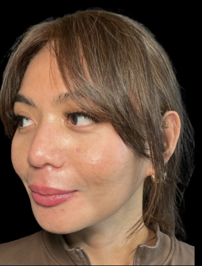 Cheek Filler after treatment at Juvly Aesthetics