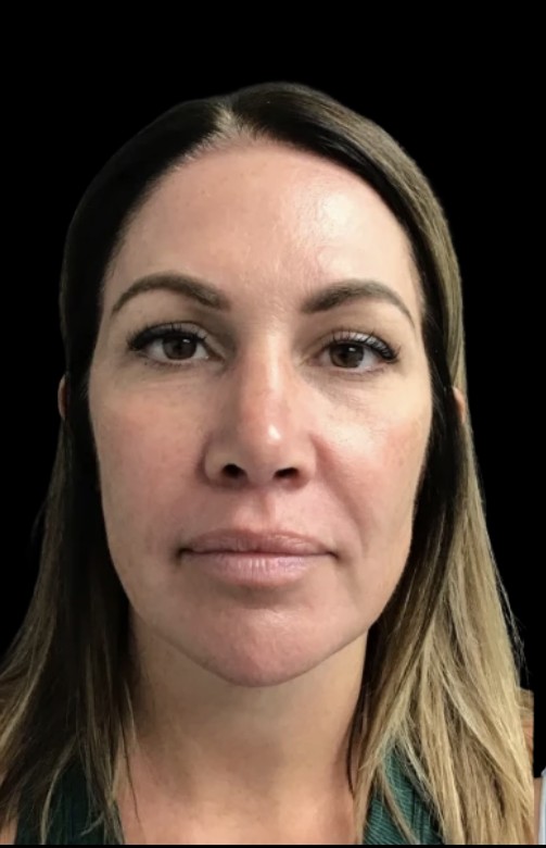 Under-Eye Treatments before treatment at Juvly Aesthetics