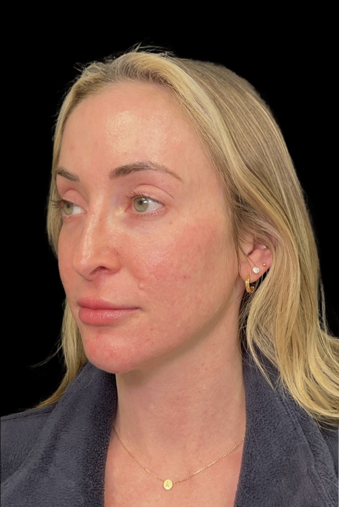Laser before treatment at Juvly Aesthetics