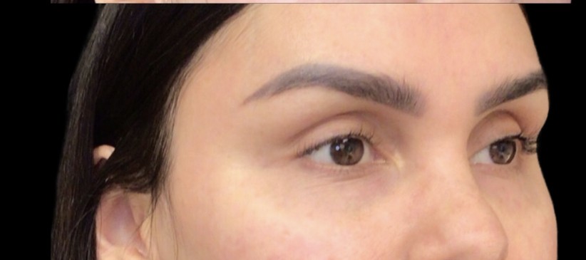 Under-Eye Treatments after treatment at Juvly Aesthetics