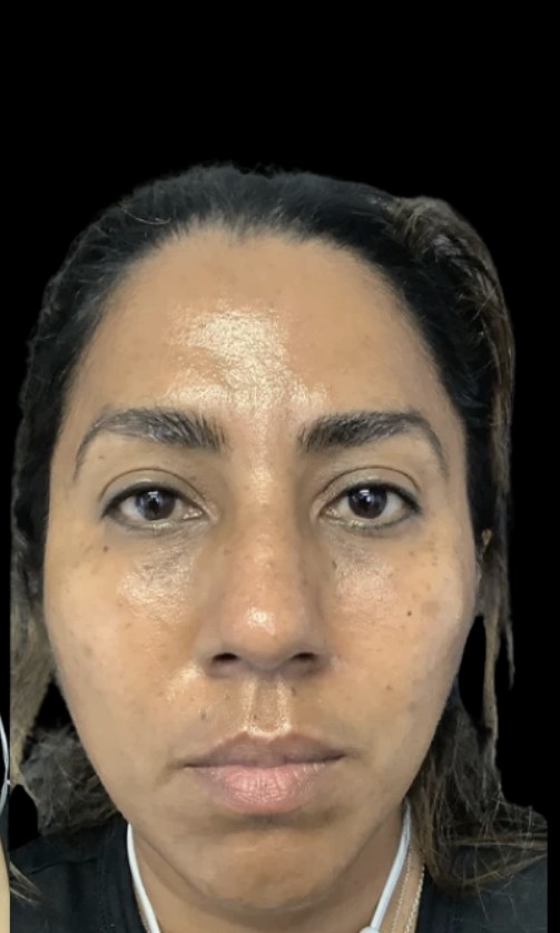 Under-Eye Treatments after treatment at Juvly Aesthetics