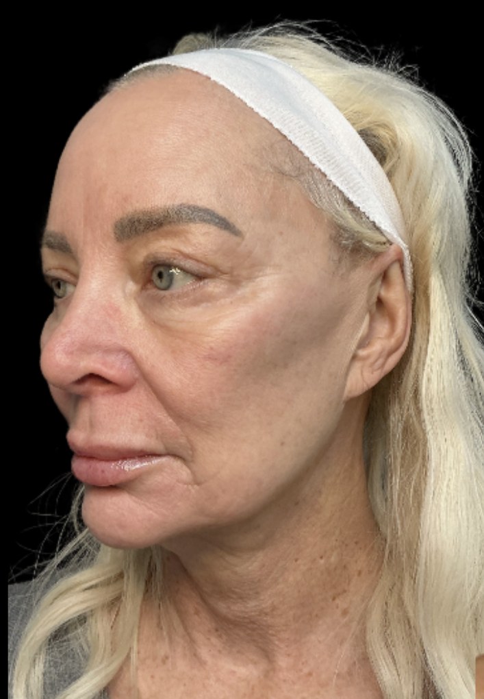 Standard Microneedling before treatment at Juvly Aesthetics
